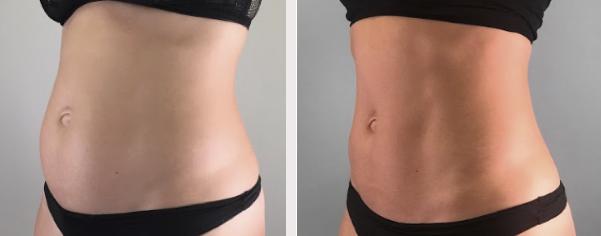 Flat Abs
